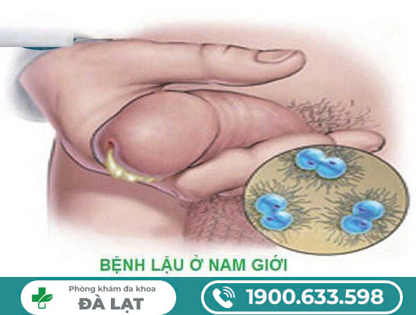 Hình ảnh minh họa