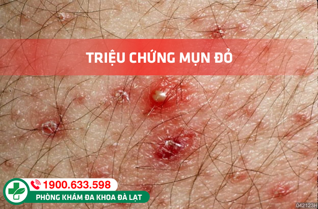 Hình ảnh minh họa